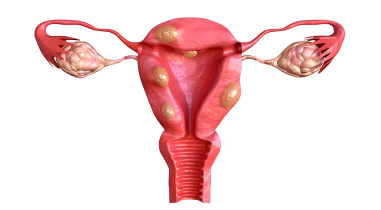 Miomas y pólipos