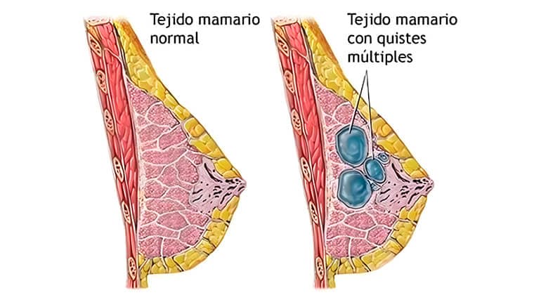 Tumores y quistes de mama