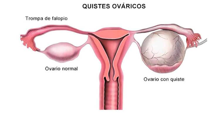 Tumores y quistes de ovario