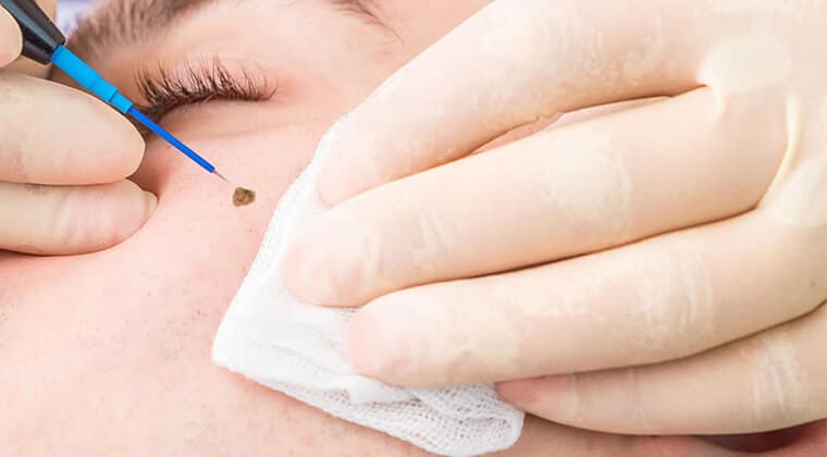 Electrocauterizaciones de verrugas y lesiones